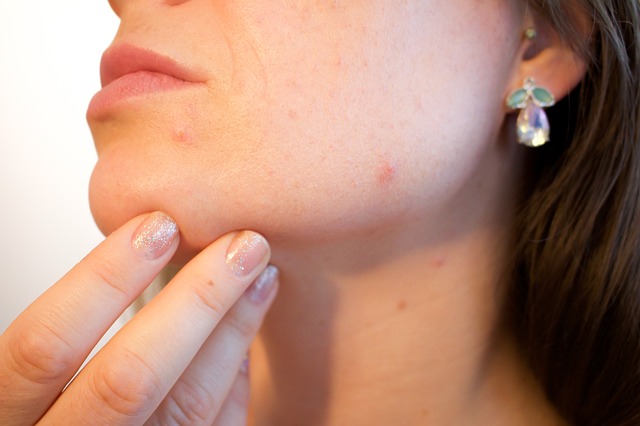 acne cbd treatment - Seaflora Skincare CBD Acne Treatement