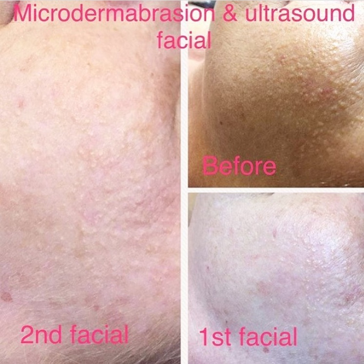 Seaflora Facial at The Beauty Chair before and after - Seaflora Skincare Seaflora Facial at The Beauty Chair before and after
