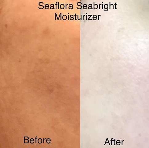 Seabright Before and After - Seaflora Skincare Seabright Moisturizer before and after picture