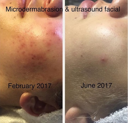 Seaflora and Beauty Chair Before and After 2 - Seaflora Skincare Seaflora facial before and after picture