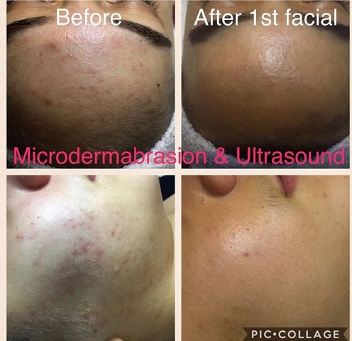 Seaflora and Beauty Chair Before and After - Seaflora Skincare Seaflora before and after picture