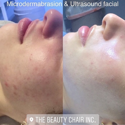Ultrasound before and after - Seaflora Skincare Seaflora Facial before and after picture