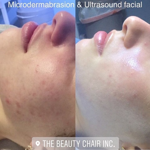 Seaflora Facial before and after picture