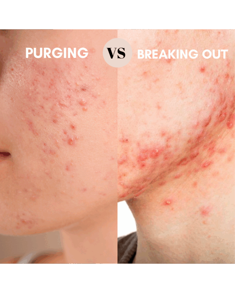 Purging vs. Breakouts: Understanding the Difference in Your Skin’s Reaction - Seaflora Skincare Difference between the skin detoxifying and breaking out due to an irritation.