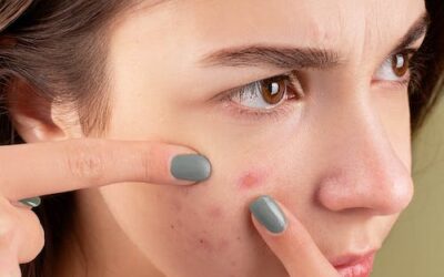 hormonal acne breakout