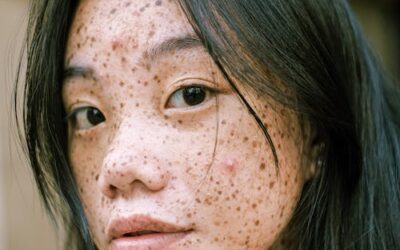 hyperpigmentation