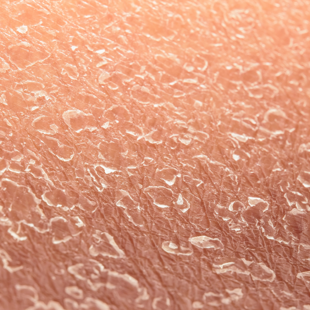 Why retinol causes flakey skin