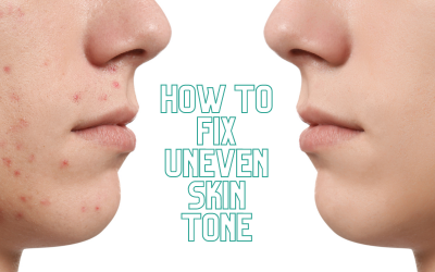 Skin Complexion: How To Fix Uneven Skin Tone