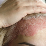 psoriasis