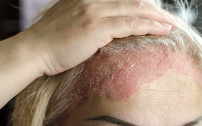 Psoriasis: Symptoms, Causes, and Natural Treatments That Work