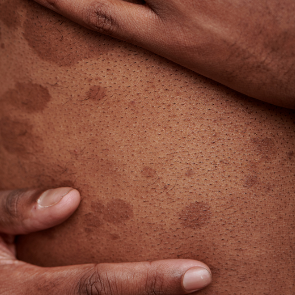 is it hyperpigmentation or a fungal infection?