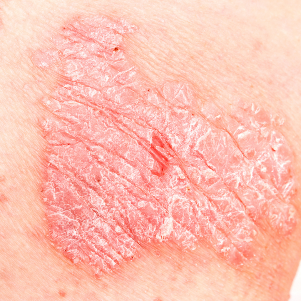 what is eczema?