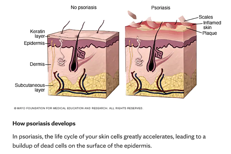 Psoriasis-Development-diagram-by-Mayo-Foundation-for-Medical-Education-and-Research - Seaflora Skincare healthy skin vs. psoriasis