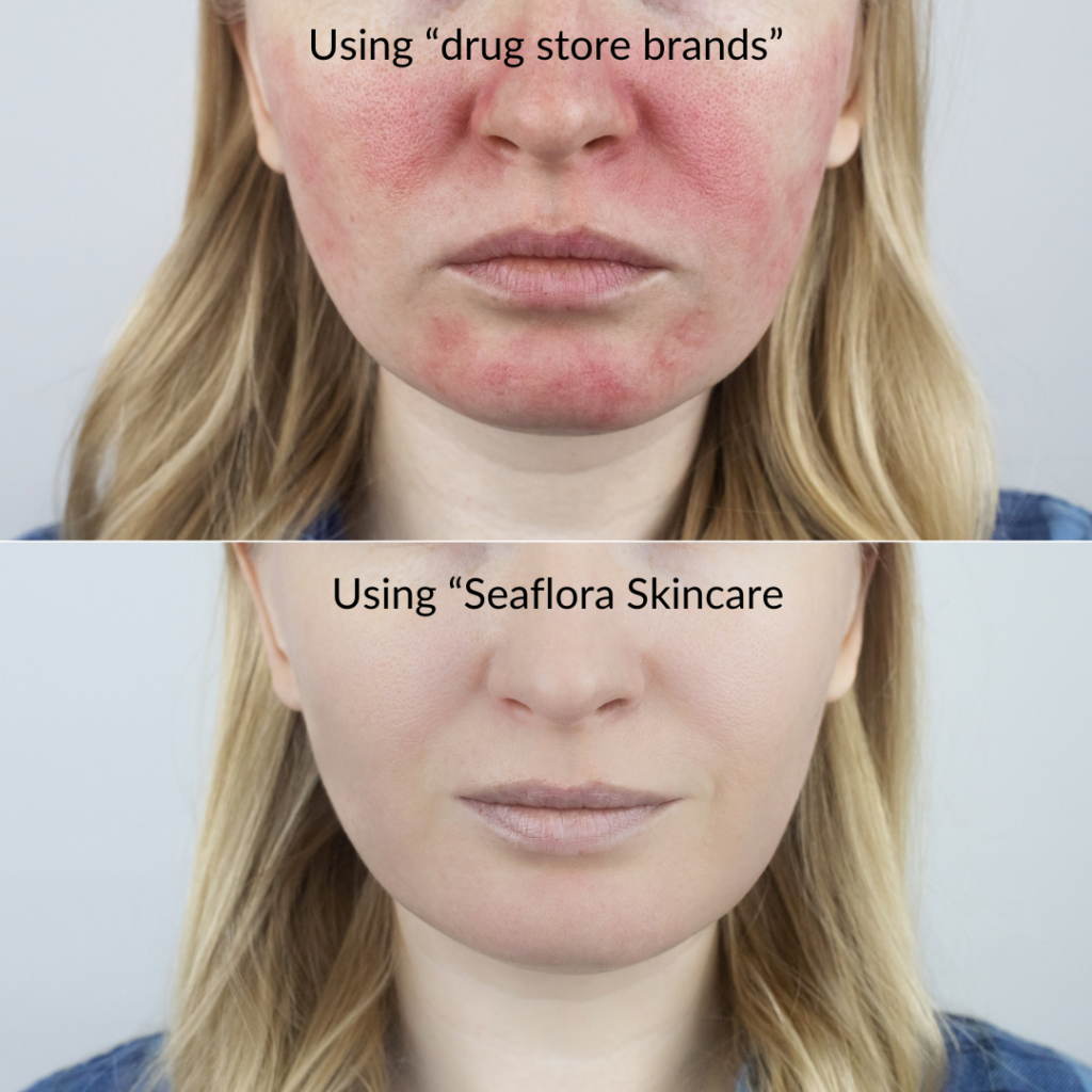 skincare for eczema
