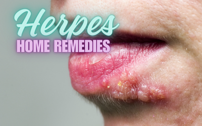 Top Home Remedies to Alleviate Herpes Symptoms: Your Essential Guide