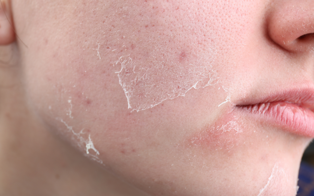 atopic dermatitis