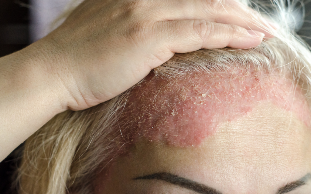 Psoriasis