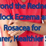 A person wearing a red t-shirt scratching their eczema with the blog title overlay: 'Beyond the Redness: Unlock Eczema and Rosacea for Clearer, Healthier Skin.