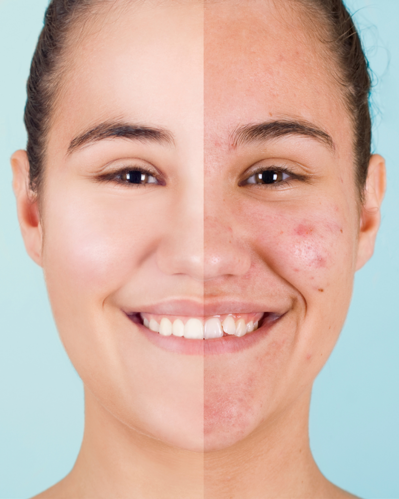 Clear Skin Transformation with Seaweed for Magnesium Support - Seaflora Skincare Before and after of a young lady using Seaweed for her magnesium deficiency.